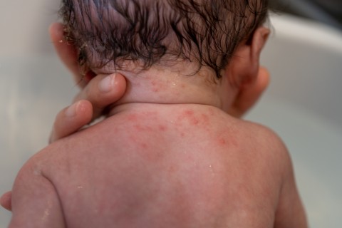 サムネイル 「乳児湿疹」は放っておけば治るって本当？ 慢性化する「アトピー」との見分け方と予防策をアレルギー医が解説